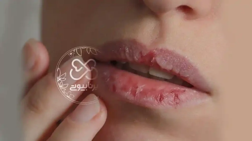 خشکی لب ناشی از کمبود کدام ویتامین است؟