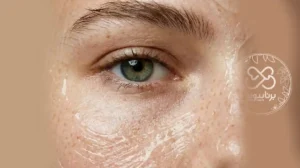 خواص پماد زینک اکساید برای رفع لک صورت | معرفی بهترین محصولات ضد‌لک