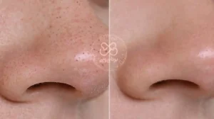 ویژگی های بهترین تونر برای بستن منافذ