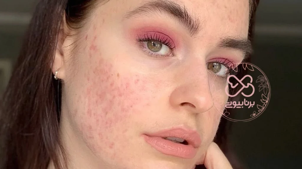 آرایش جای جوش صورت
